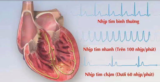 nguyen-nhan-dan-den-can-benh-tim-dap-cham